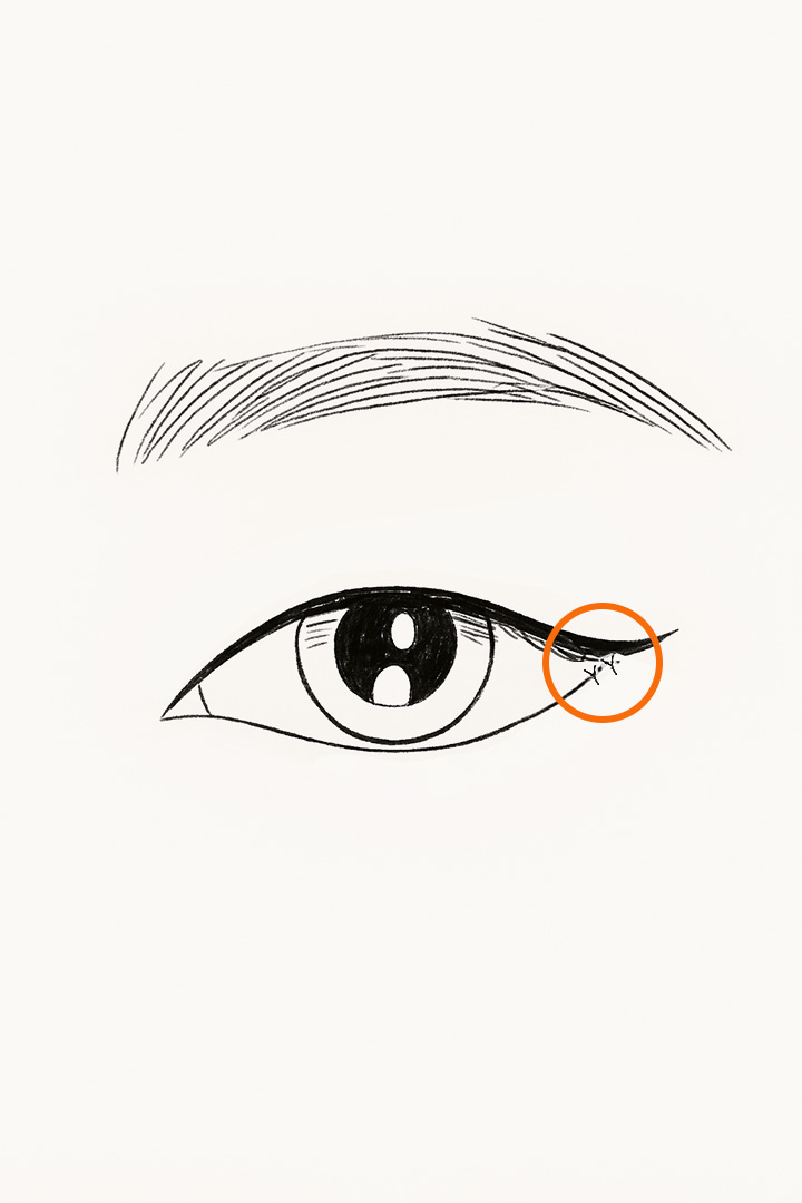 Suture after fixing[b] to the periosteum.