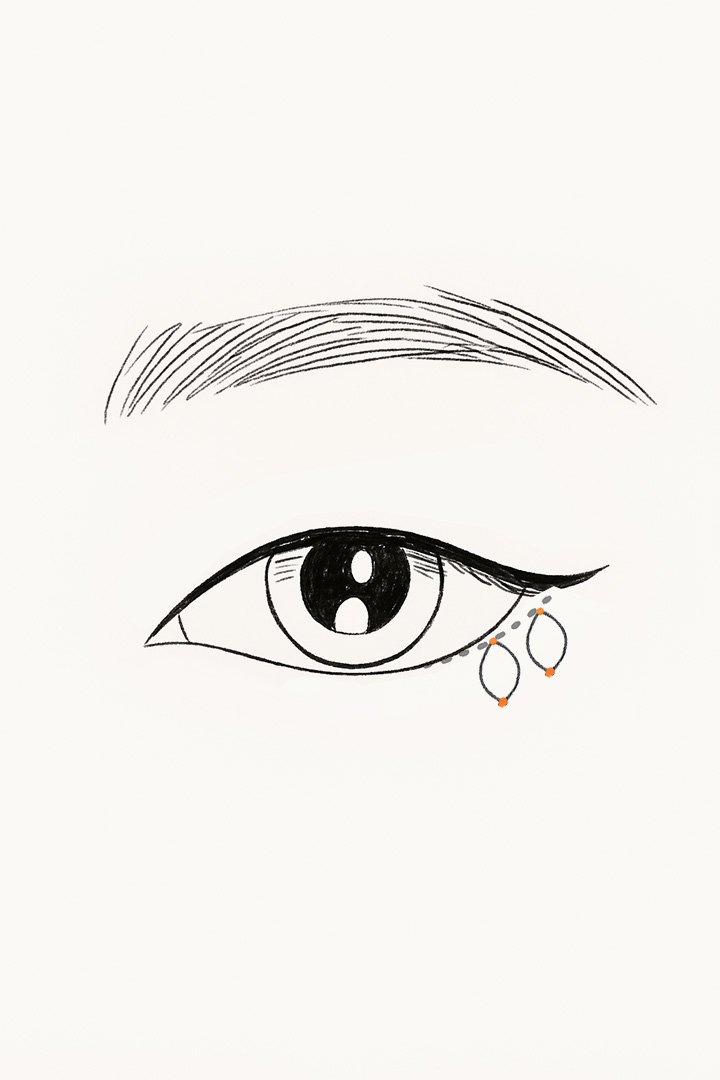 Pull toward the[b] capsulopalpebral fascia[b] and secure it firmly.