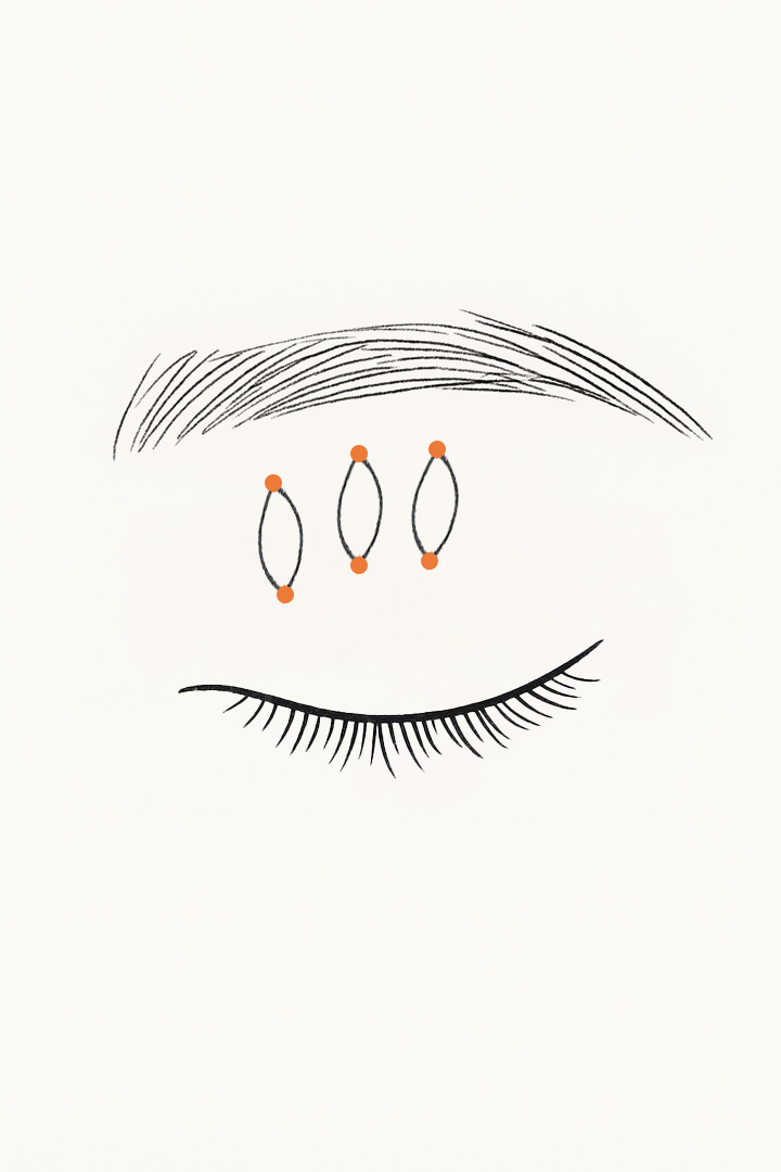 The thread is used[b] to pull the Müller’s muscle.