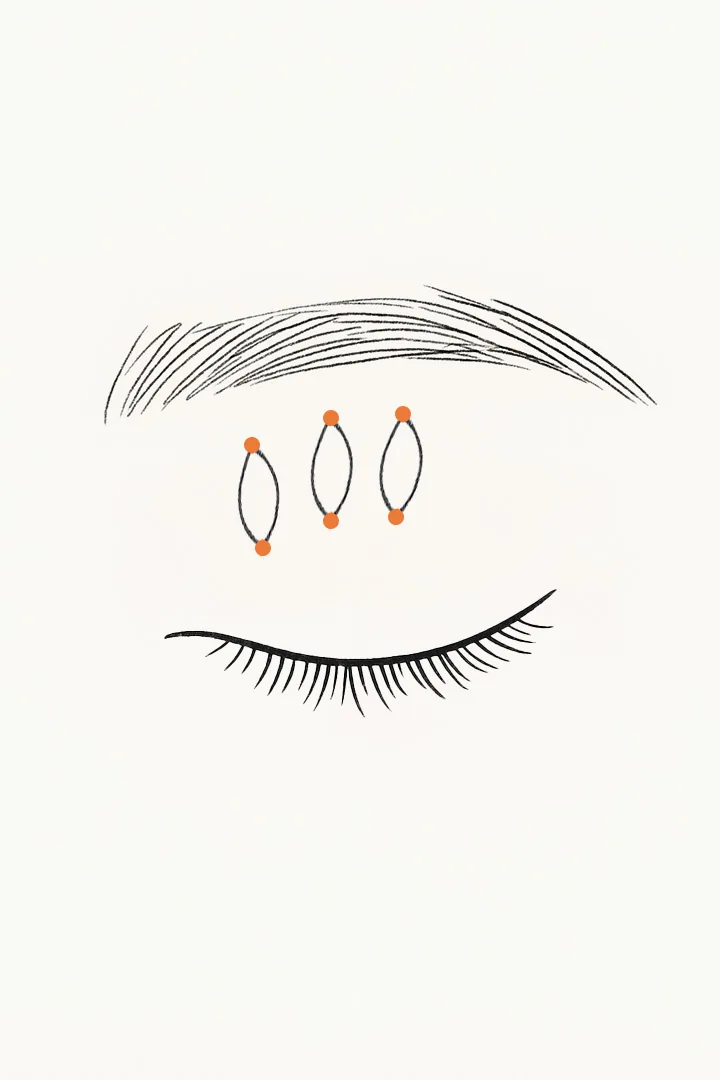 The thread is used[b] to pull the Müller’s muscle.