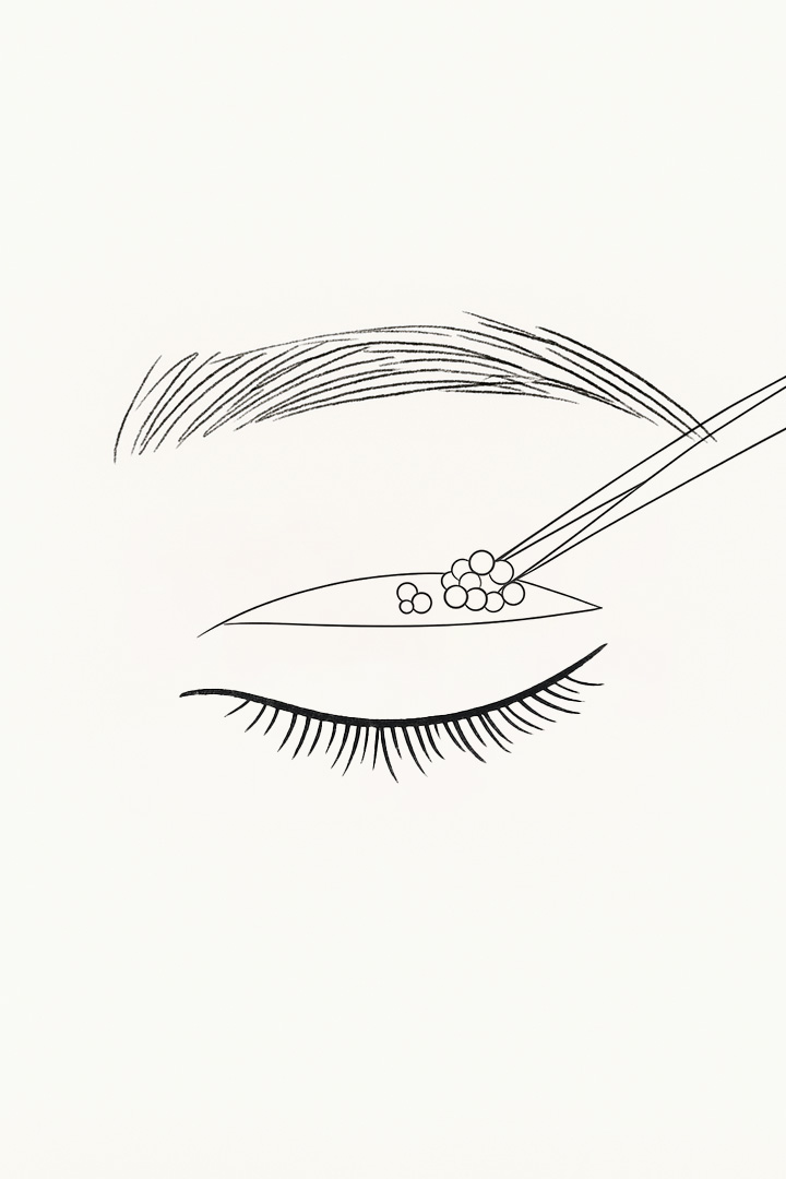 Selectively remove unnecessary skin and fat.