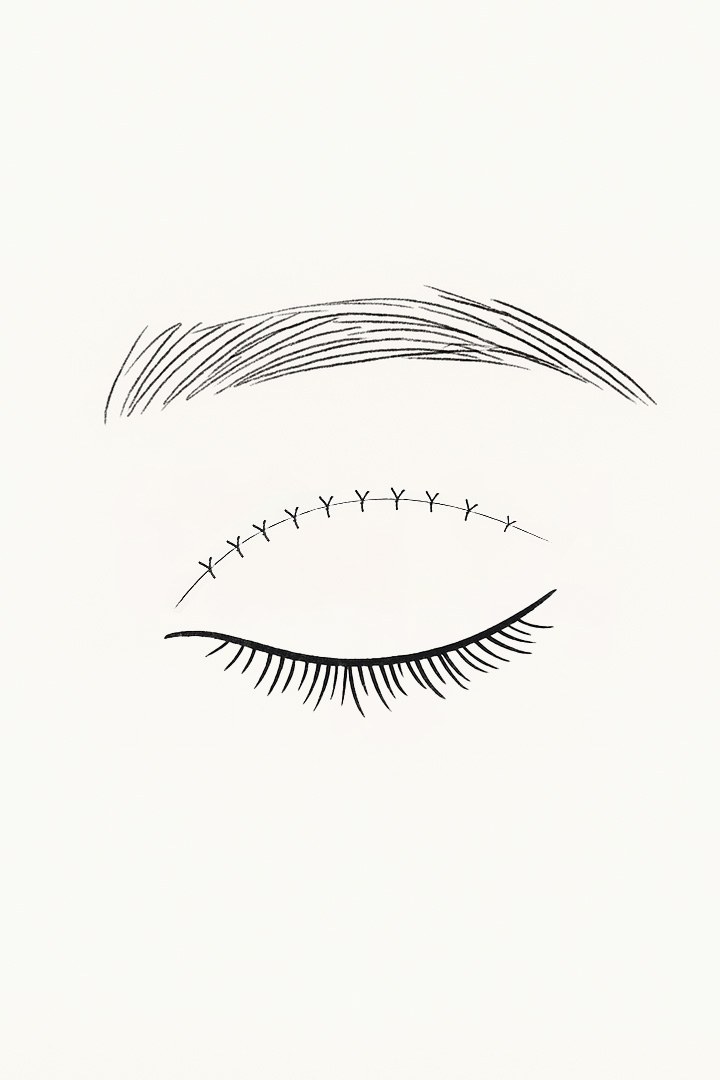 Fix the orbicularis oculi muscle to the tarsal plate and the end of the levator muscle.