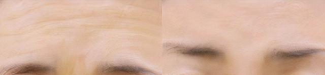 미간 주름 & 눈 처짐 개선