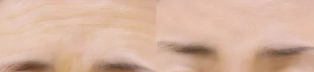 미간 주름 & 눈 처짐 개선