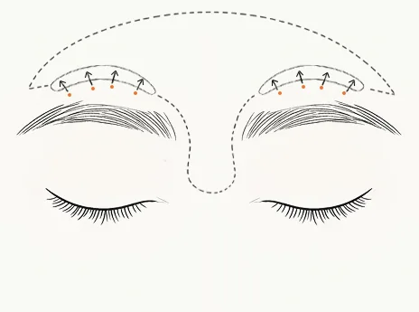 By precisely releasing the brow retaining ligaments,[b] the eyebrows are balanced symmetrically,[b] creating clearer eye contours[b] and ensuring long-lasting forehead lift results.