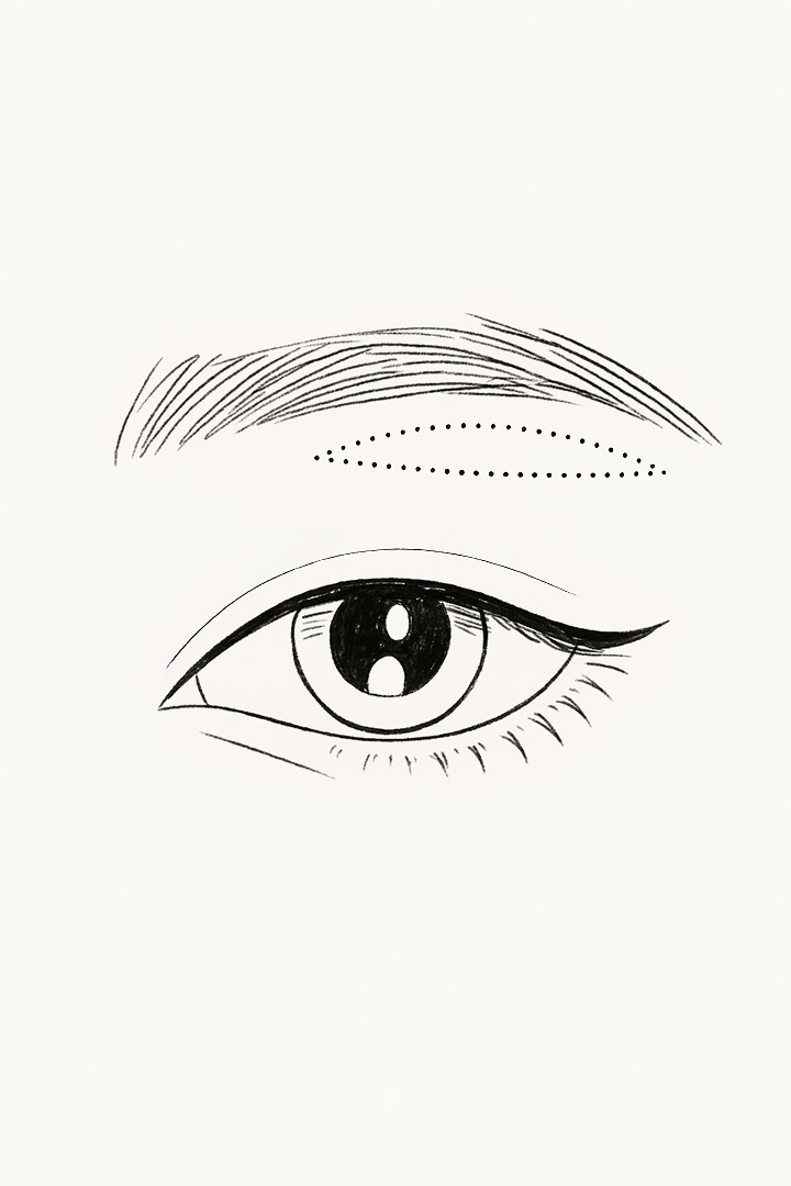 The skin is designed[b] by marking the necessary excision beneath the eyebrows.