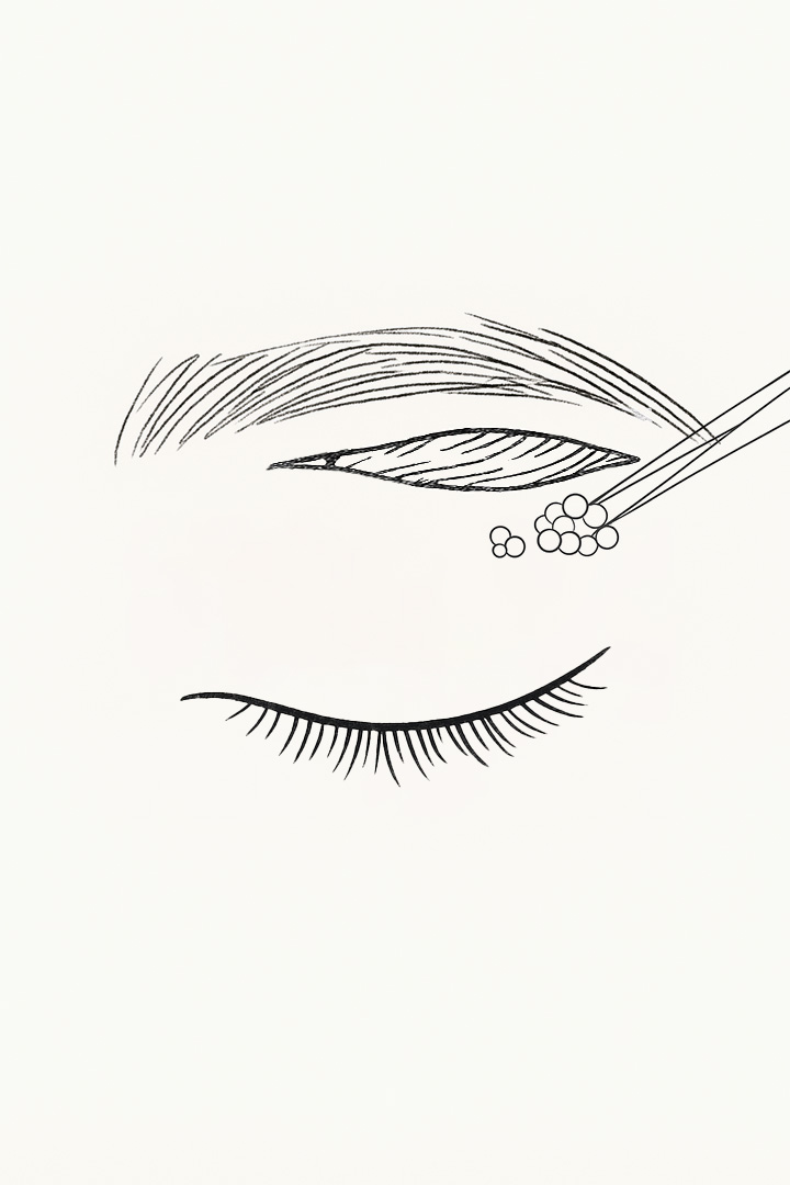 After the incision,[b] sagging skin, fat, and[b] muscle are removed.