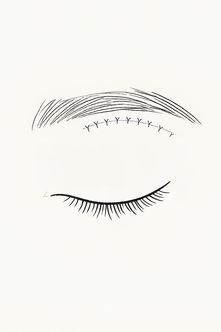 To prevent sagging,[b] the skin is pulled and[b] sutured to the periosteum.