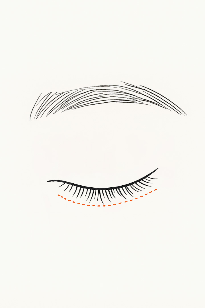 An incision is made along[b] the sagging skin beneath[b] the eyes.