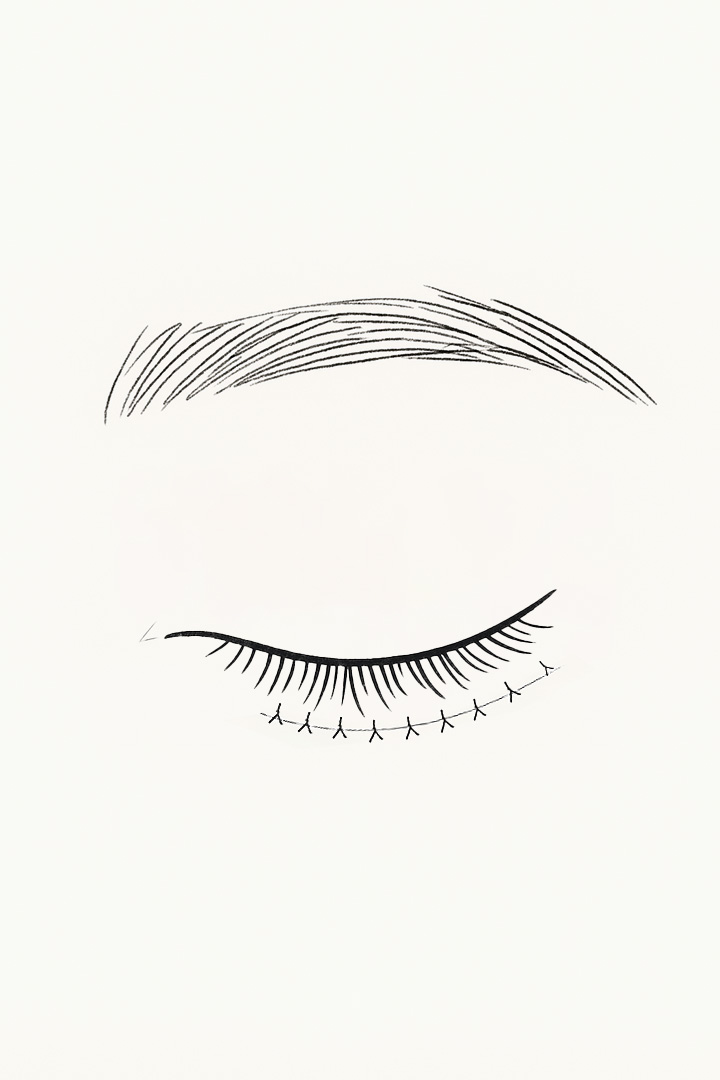 Excess skin is removed,[b] followed by suturing.