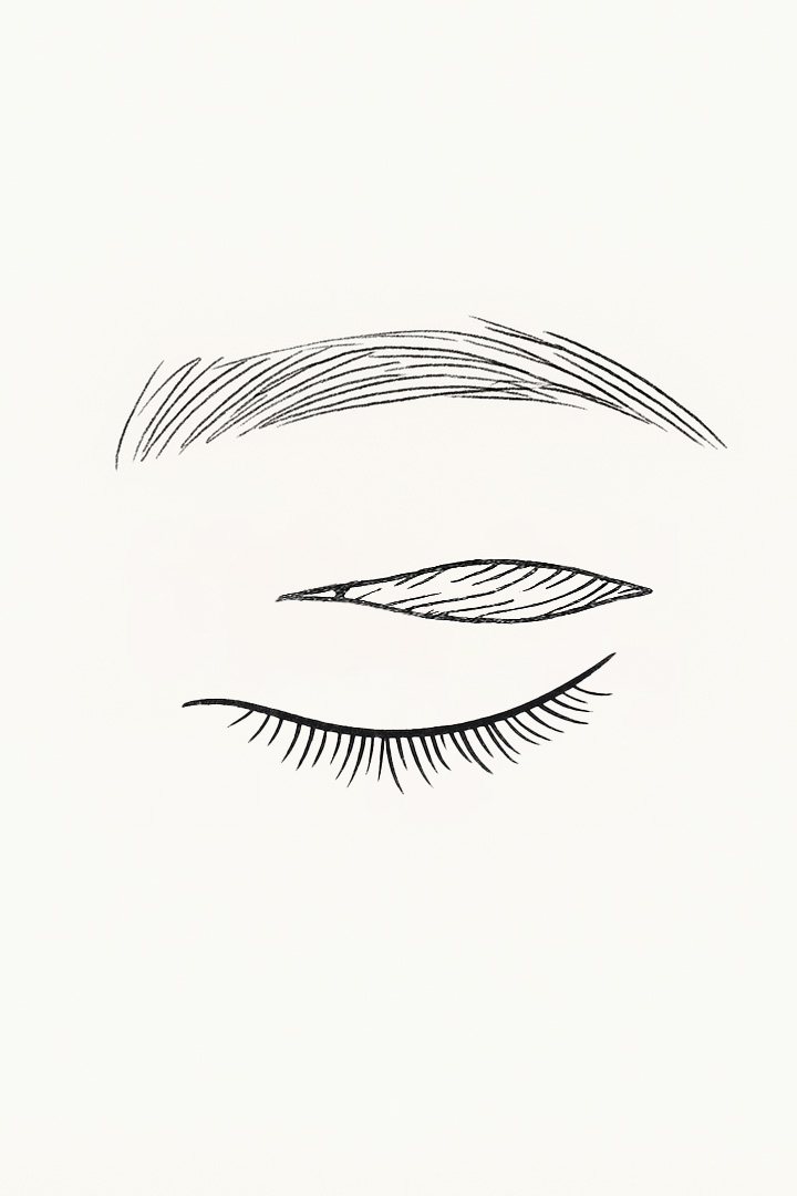 An incision is made along the sagging upper skin.